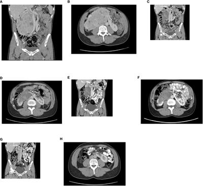 Neoadjuvant nivolumab and cabozantinib in advanced renal cell carcinoma in a horseshoe kidney – how to achieve a safe and radical resection? a case report and review of the literature